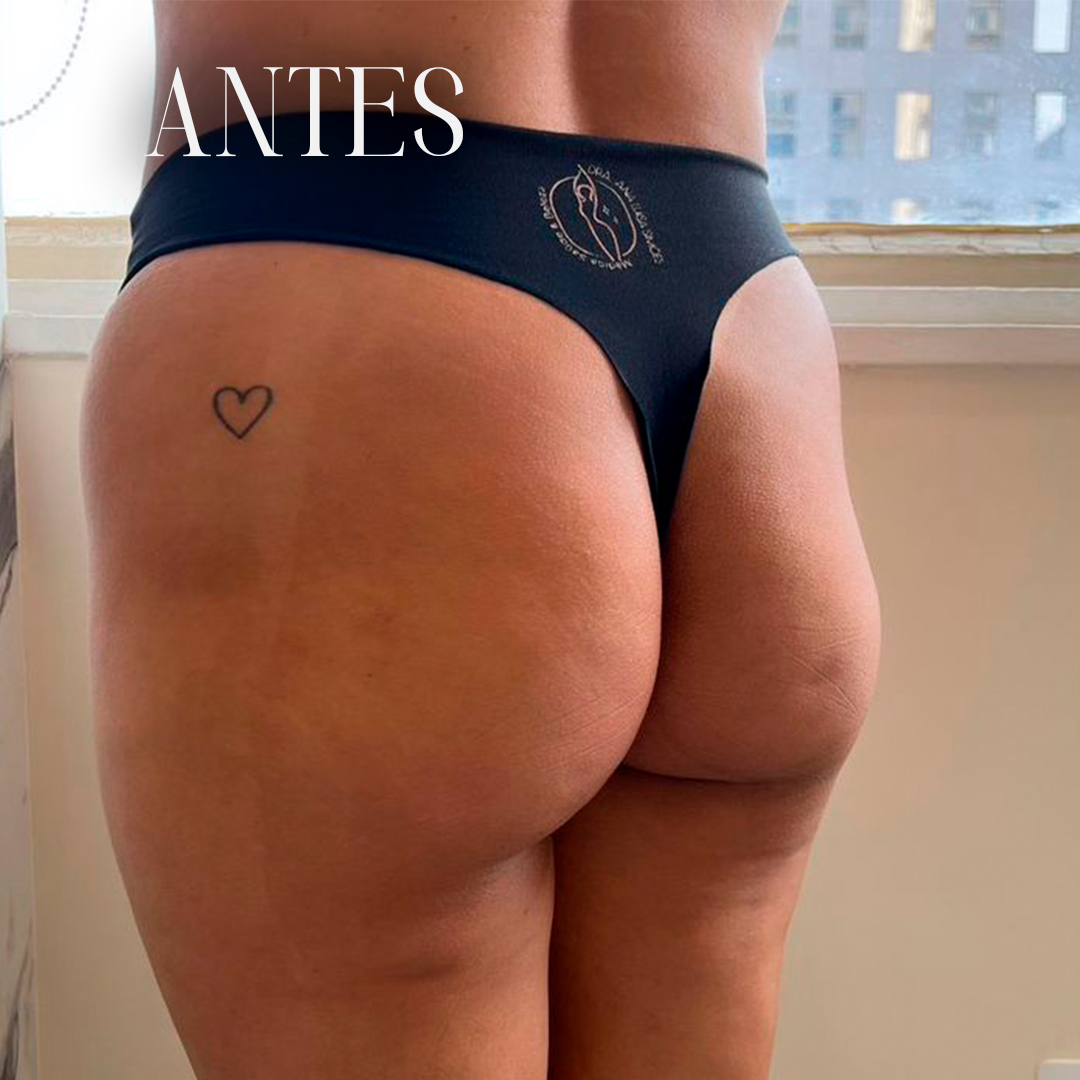 Resultado antes e depois 1