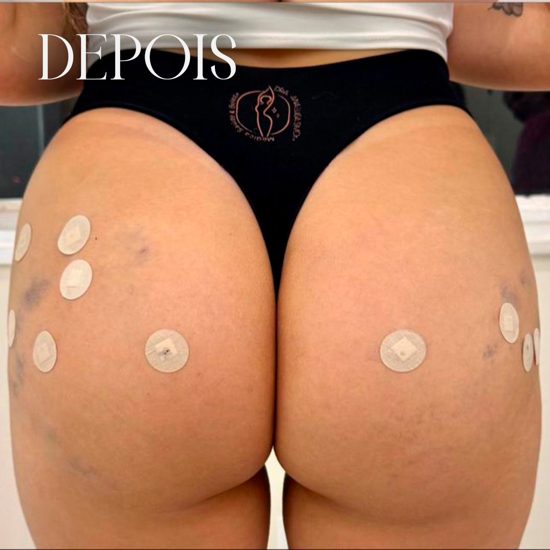 Resultado antes e depois 4